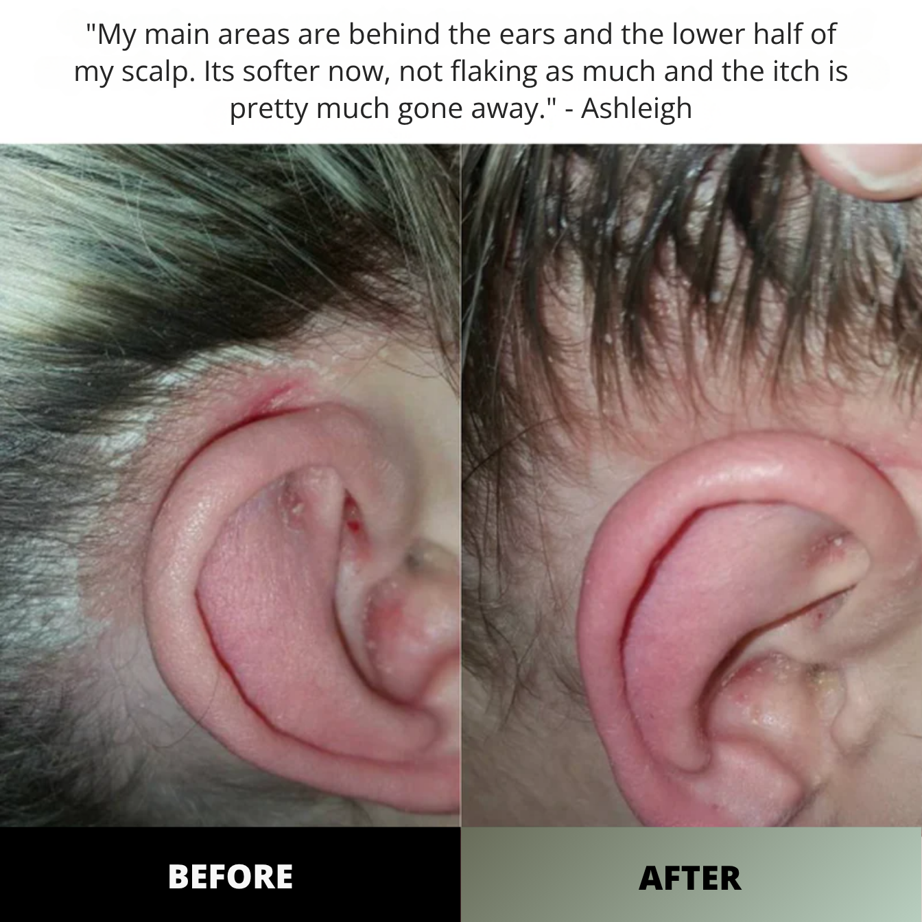 Simply Herbal™ Dermaclear Complex