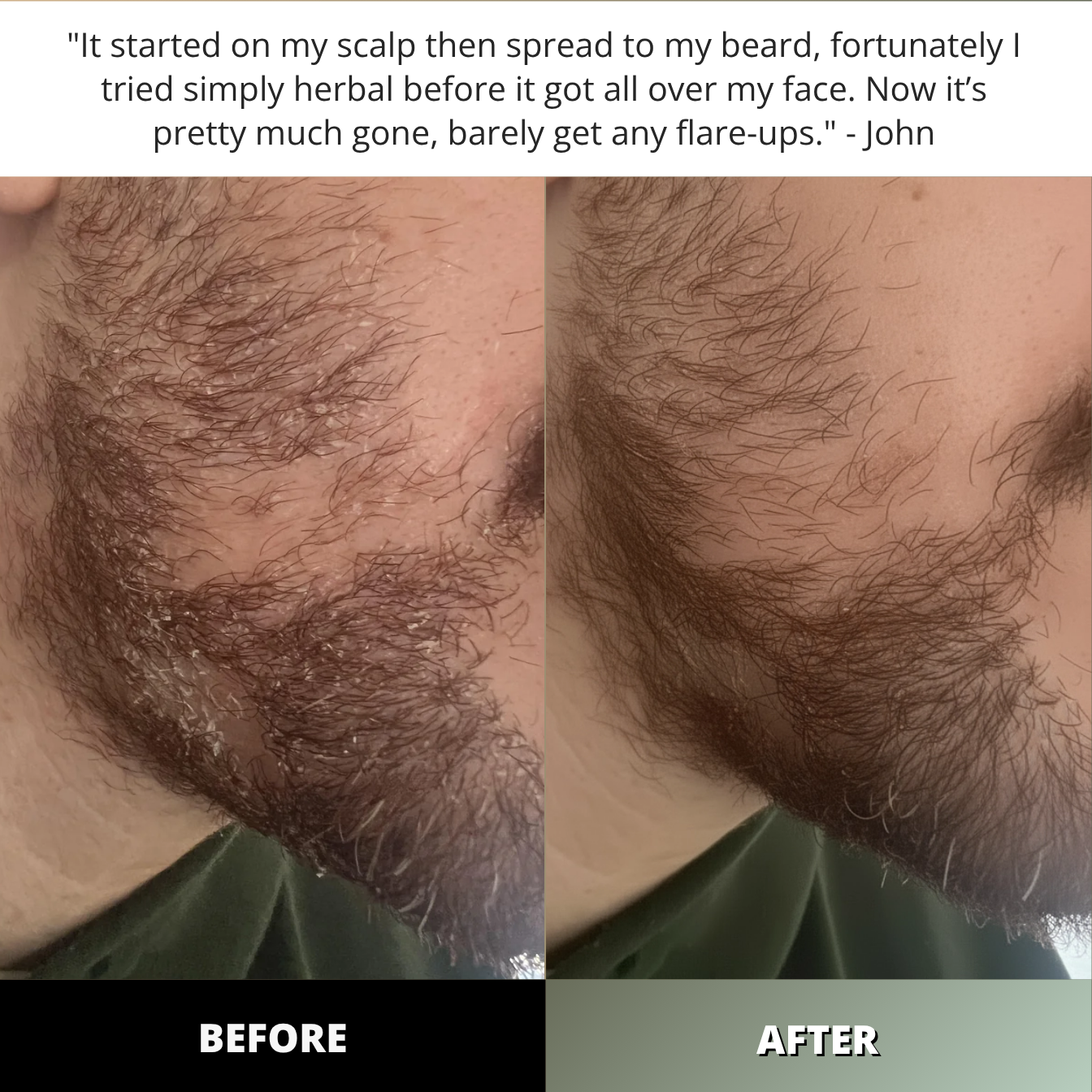 Simply Herbal™ Dermaclear Complex